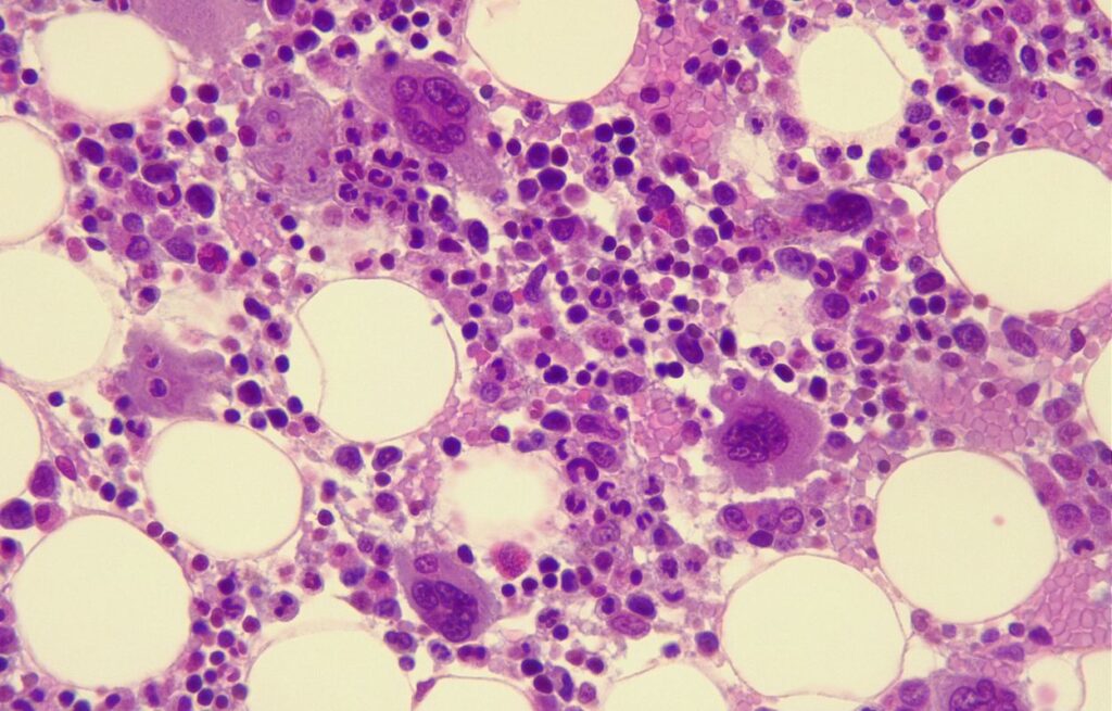 Bone Marrow Transplantation