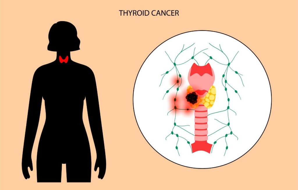Thyroid Cancer