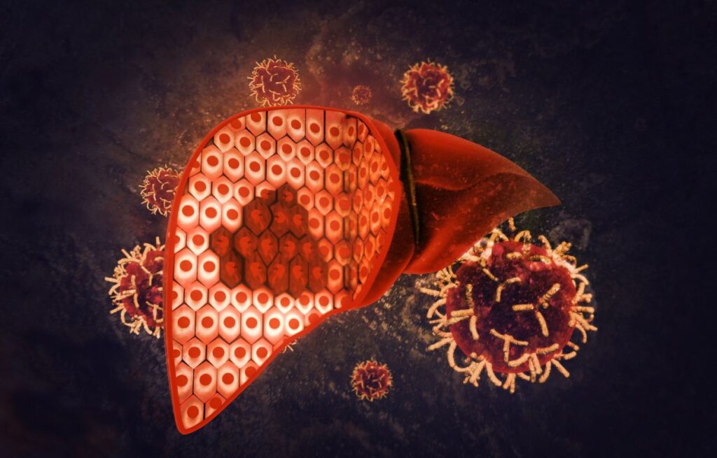 Hepatocellular Carcinoma