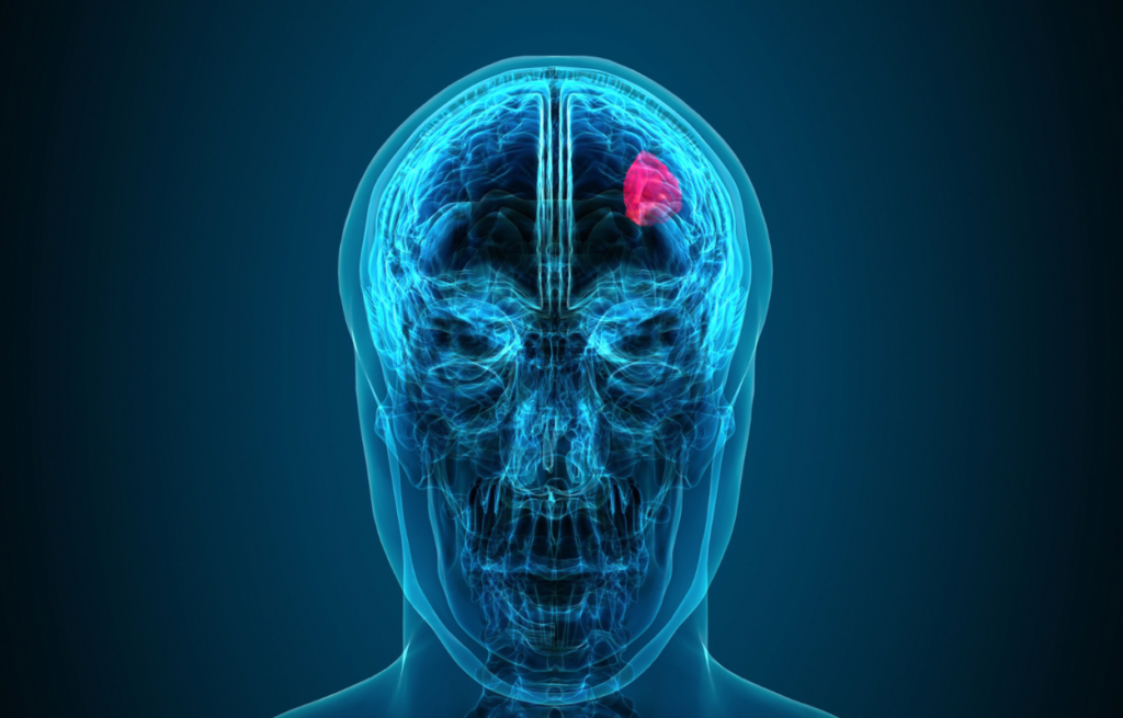 Radiosurgery for Breast Cancer Metastasized to the Brain