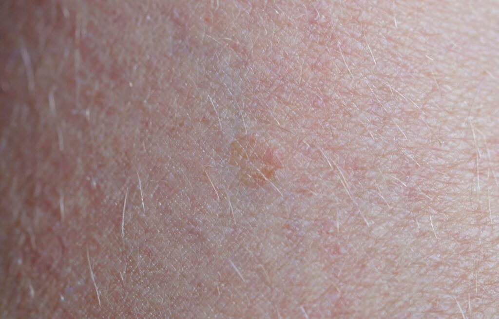 Basal Cell Carcinoma