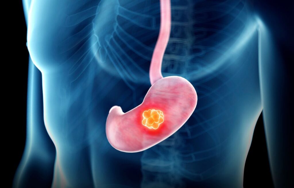 Gastric Cancer